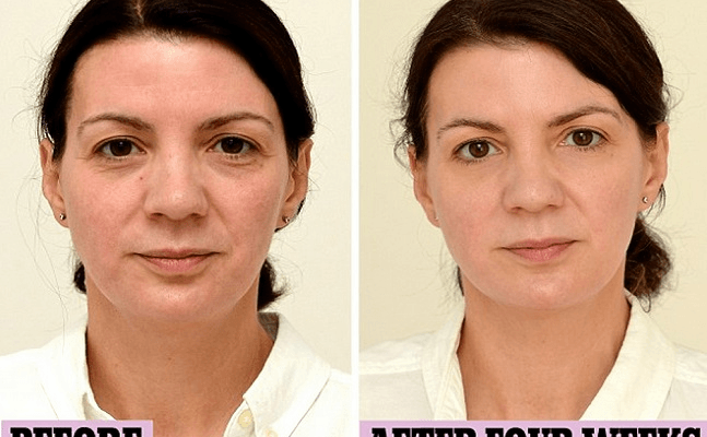 Mulher mostra as mudanças no rosto depois de passar a beber 3 litros de água por dia